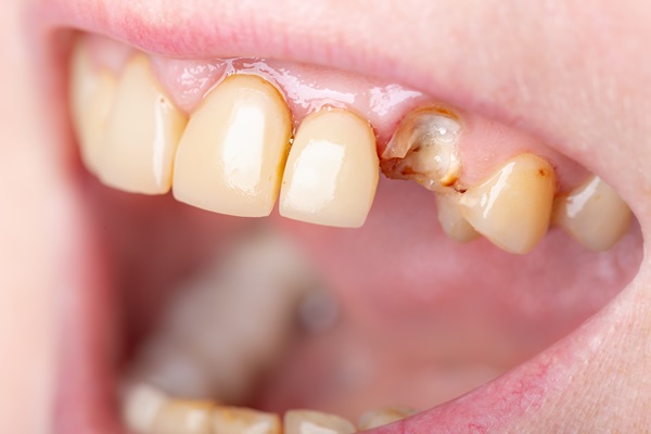 How Endodontists Repair Cracked Teeth