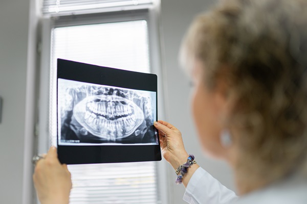 An Endodontist Describes Severe Root Canal Cases